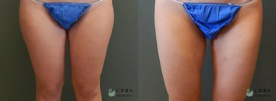 Liposuction: Patient 9 - Before and After  