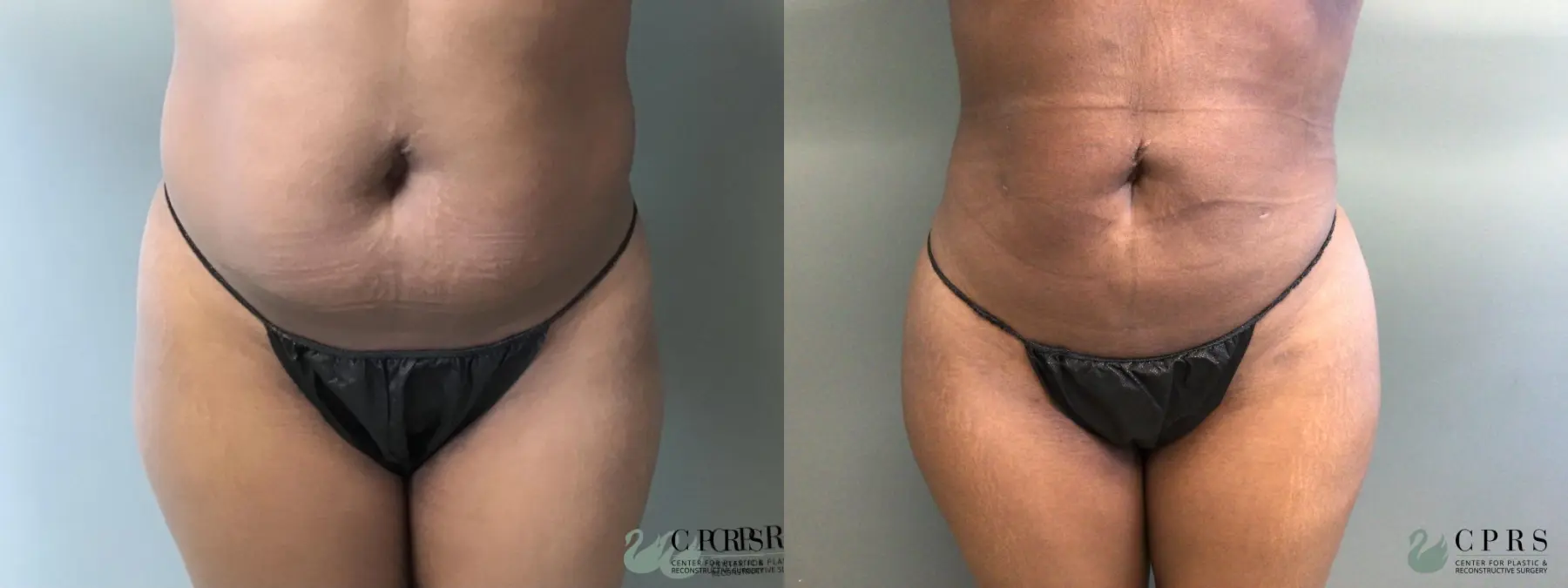 Liposuction: Patient 9 - Before and After  