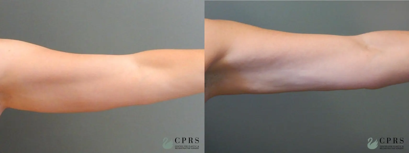 Liposuction: Patient 12 - Before and After  