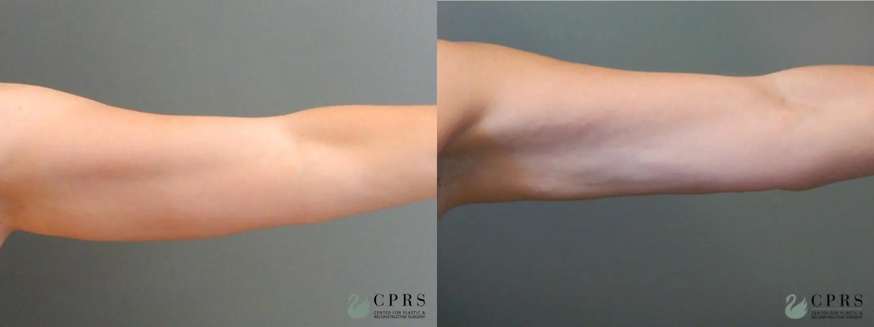 Liposuction: Patient 13 - Before and After  