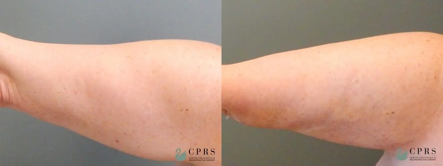 Liposuction: Patient 8 - Before and After  