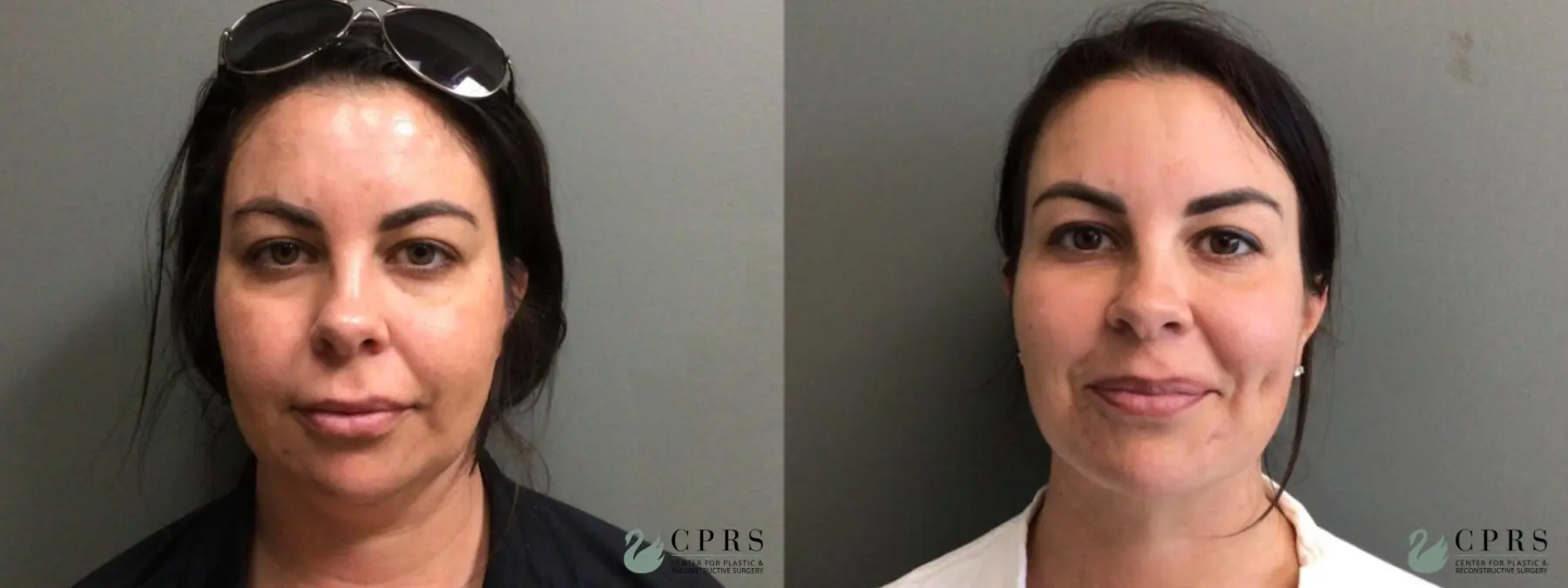 Liposuction: Patient 18 - Before and After  