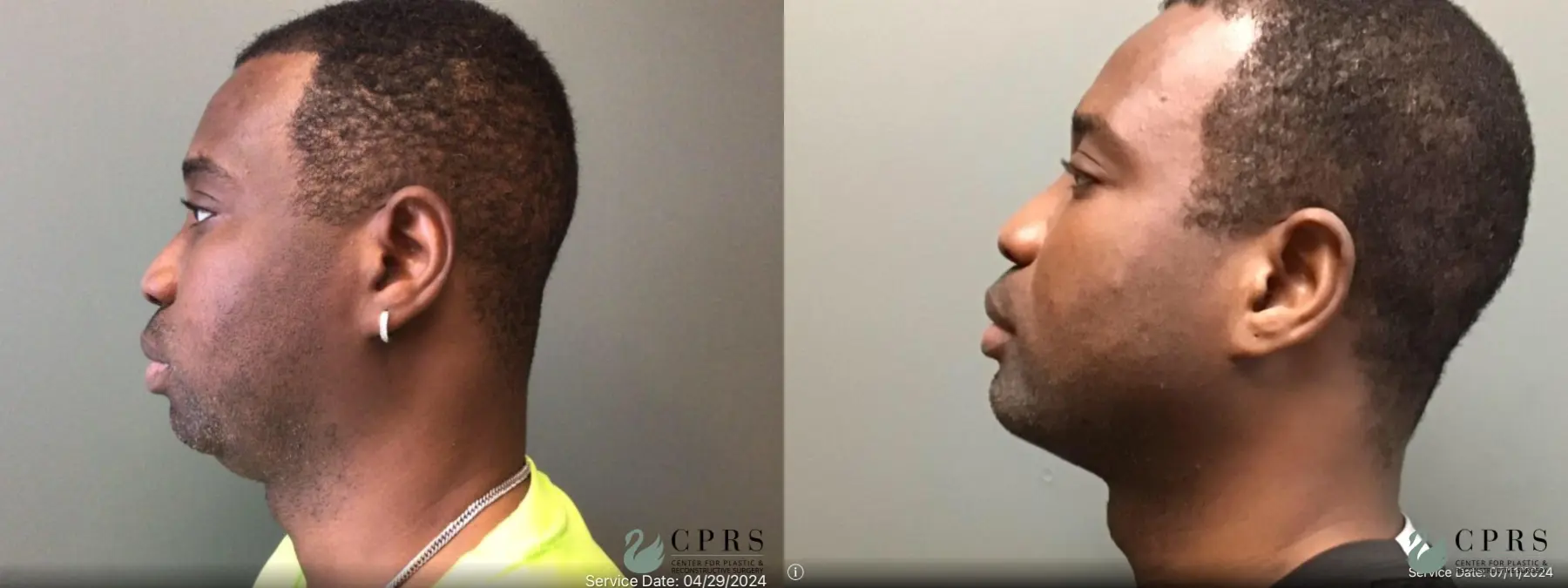 Liposuction: Patient 21 - Before and After  