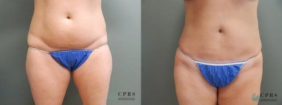 Mini Tummy Tuck: Patient 1 - Before and After  