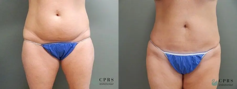 Tummy Tuck & Mini Tummy Tuck for Baltimore, Ellicott City