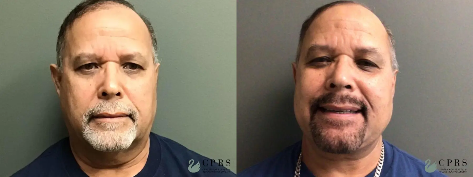 Neck Lift: Patient 2 - Before and After  