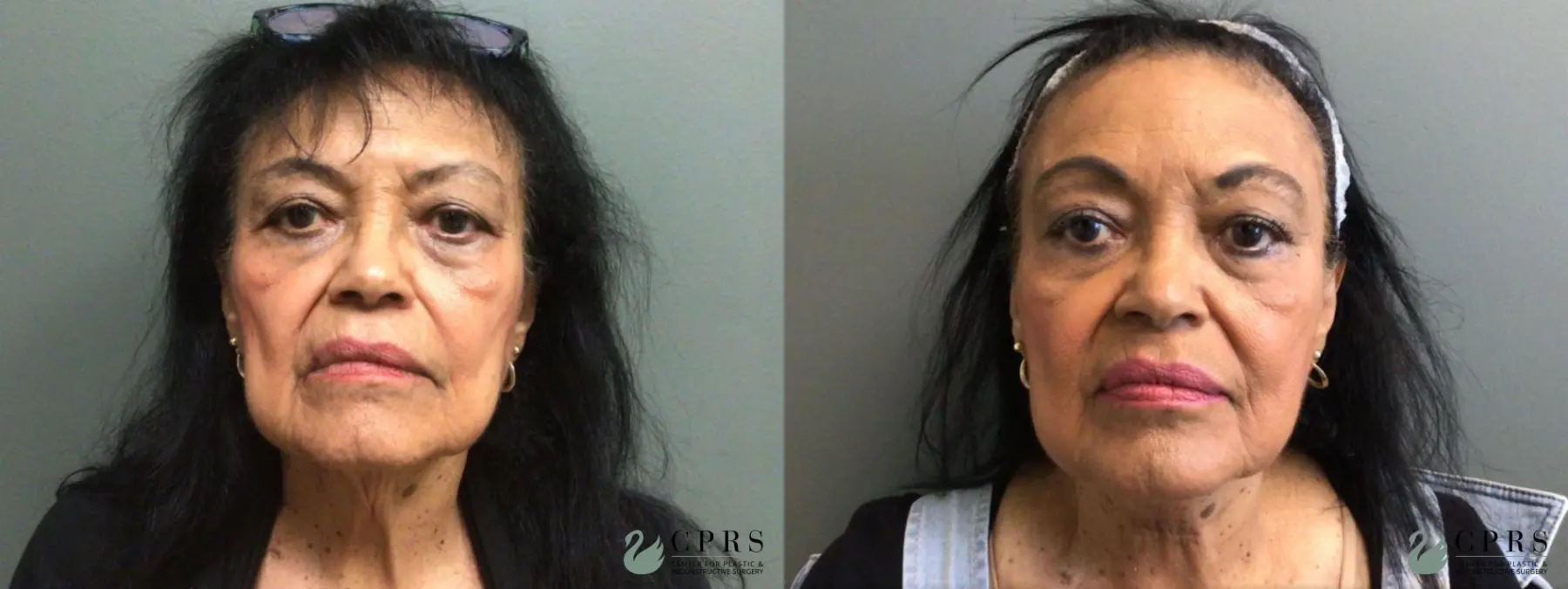 Neck Lift: Patient 3 - Before and After 1