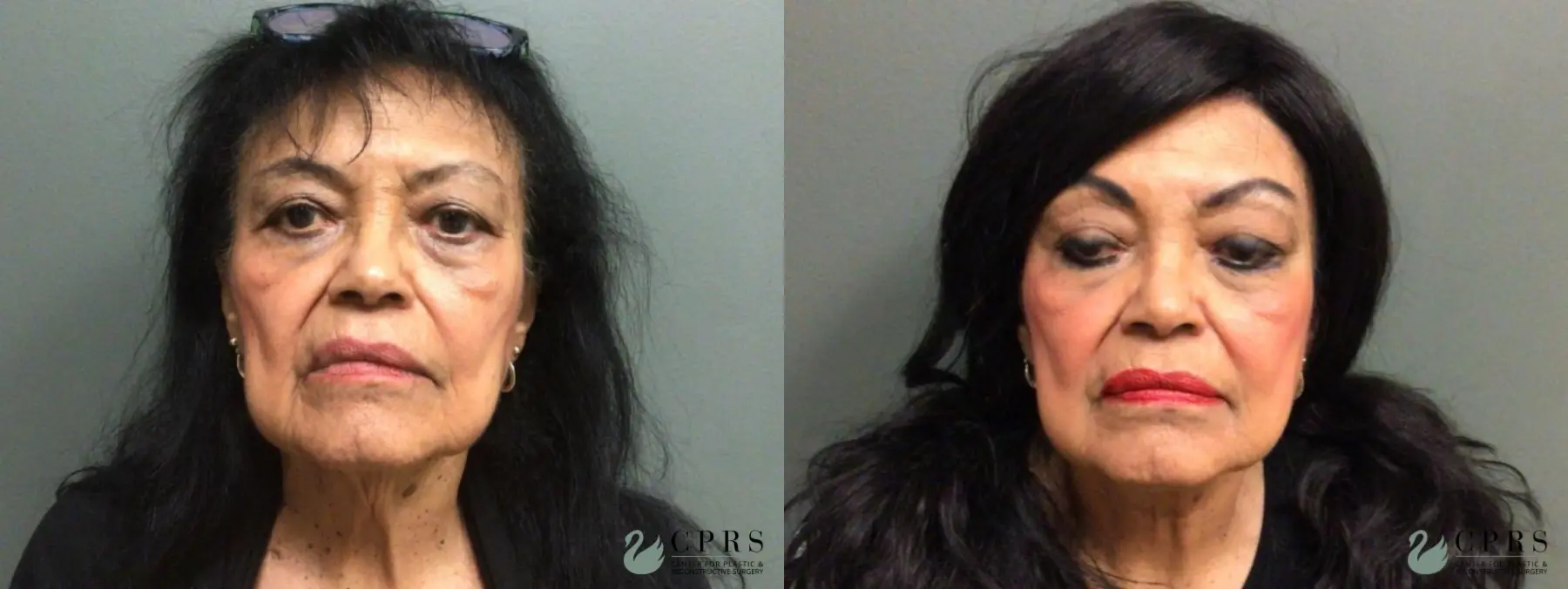 Neck Lift: Patient 3 - Before and After  