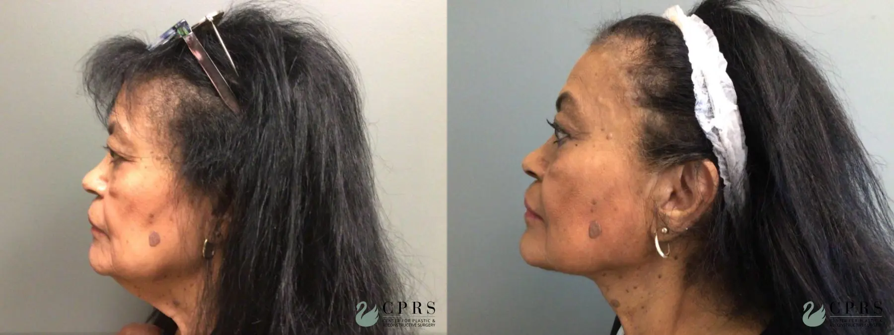 Neck Lift: Patient 3 - Before and After 3