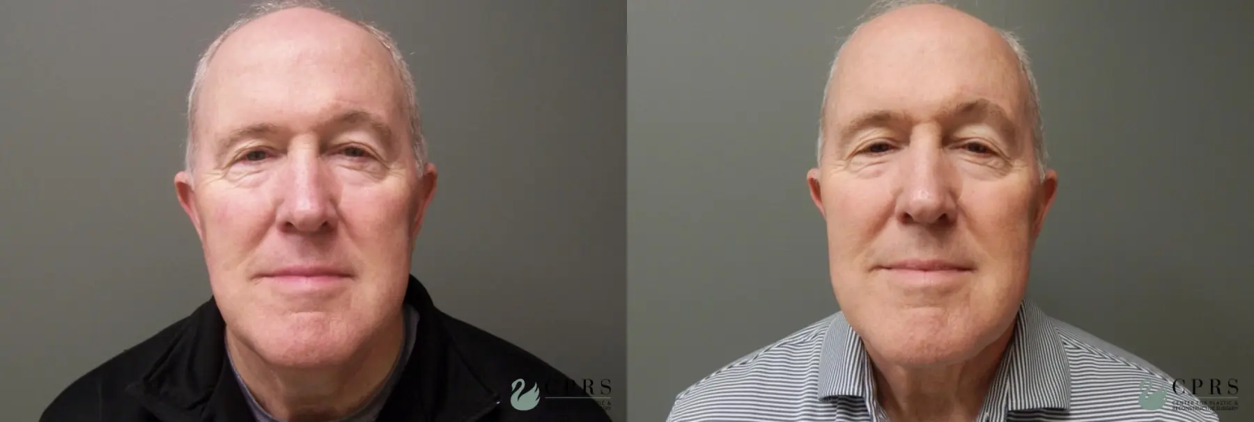 Neck Lift: Patient 1 - Before and After  