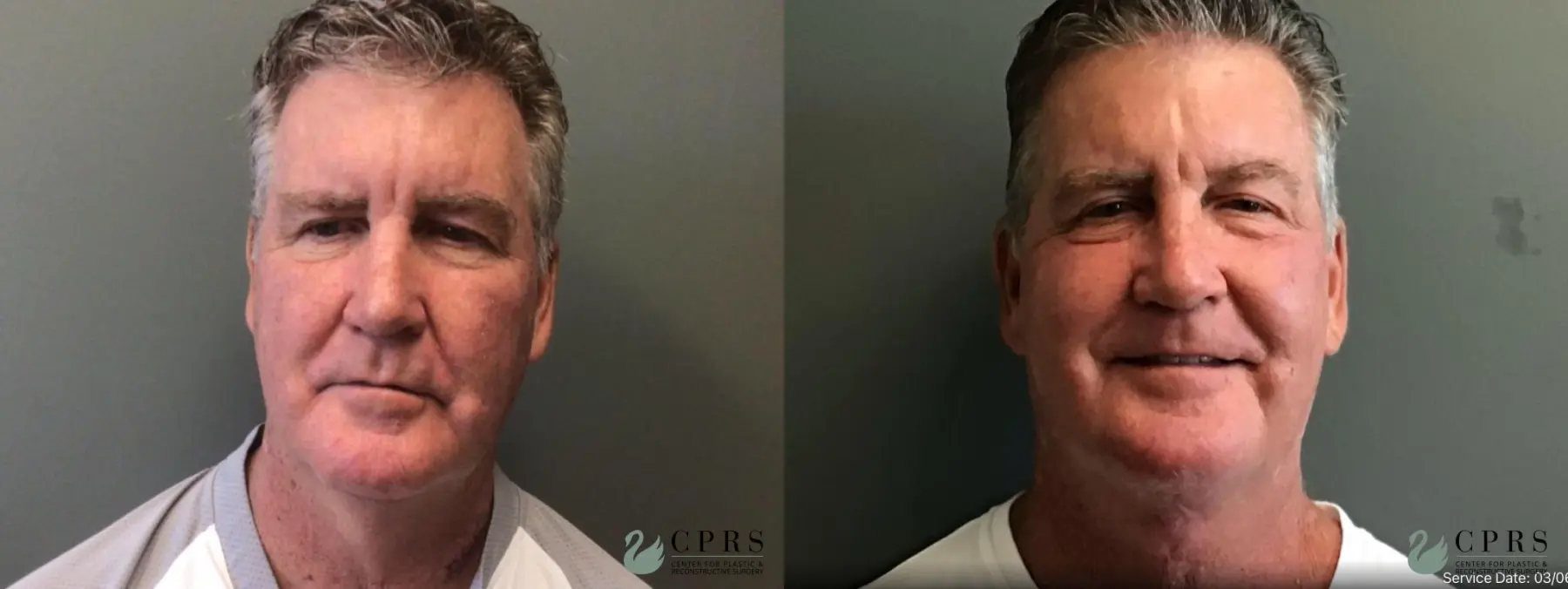 Neck Lift: Patient 4 - Before and After  
