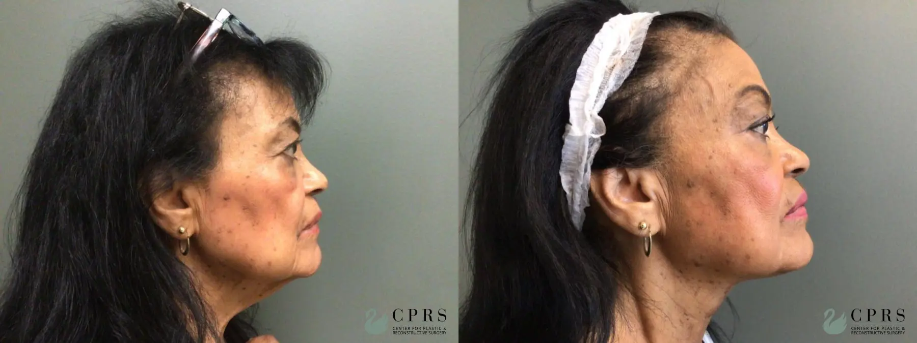 Neck Lift: Patient 3 - Before and After 2