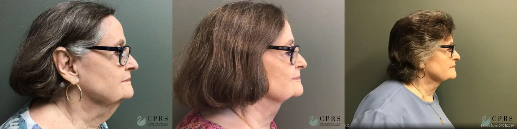 Neck Lift: Patient 2 - Before and After  