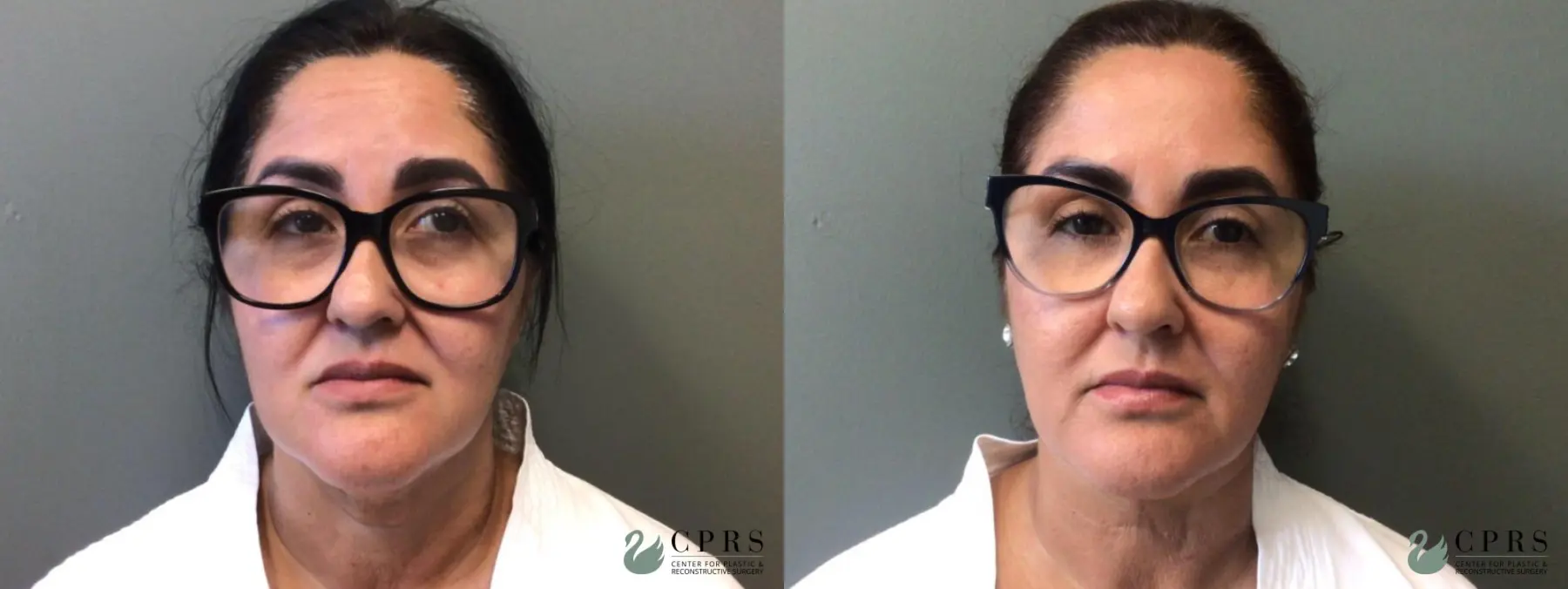 Neck Lift: Patient 1 - Before and After  