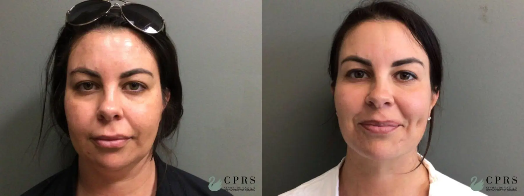 Neck Lift: Patient 2 - Before and After  