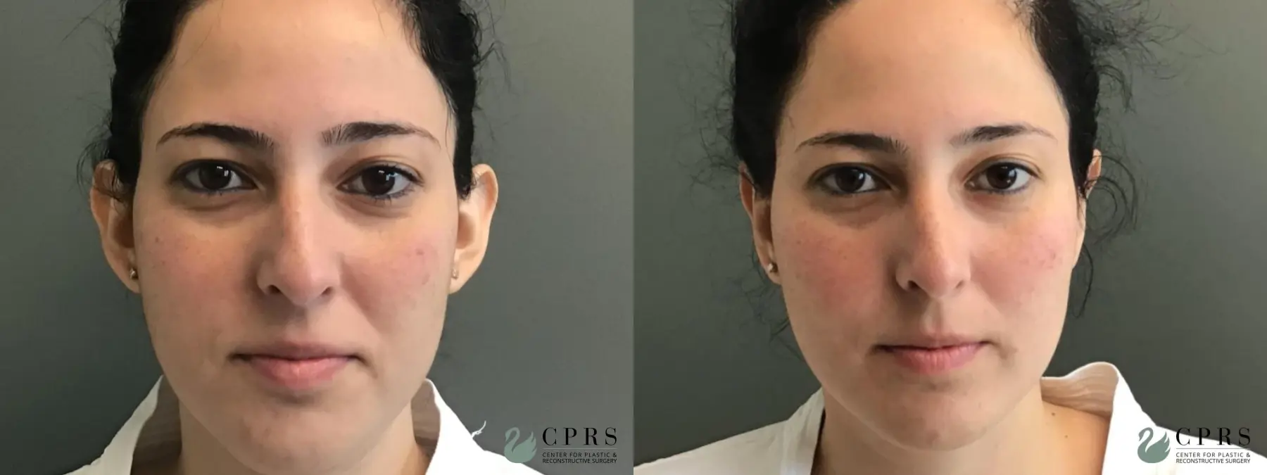 Otoplasty: Patient 2 - Before and After  