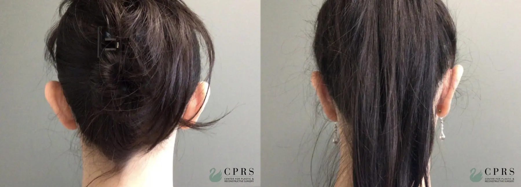 Otoplasty: Patient 1 - Before and After  