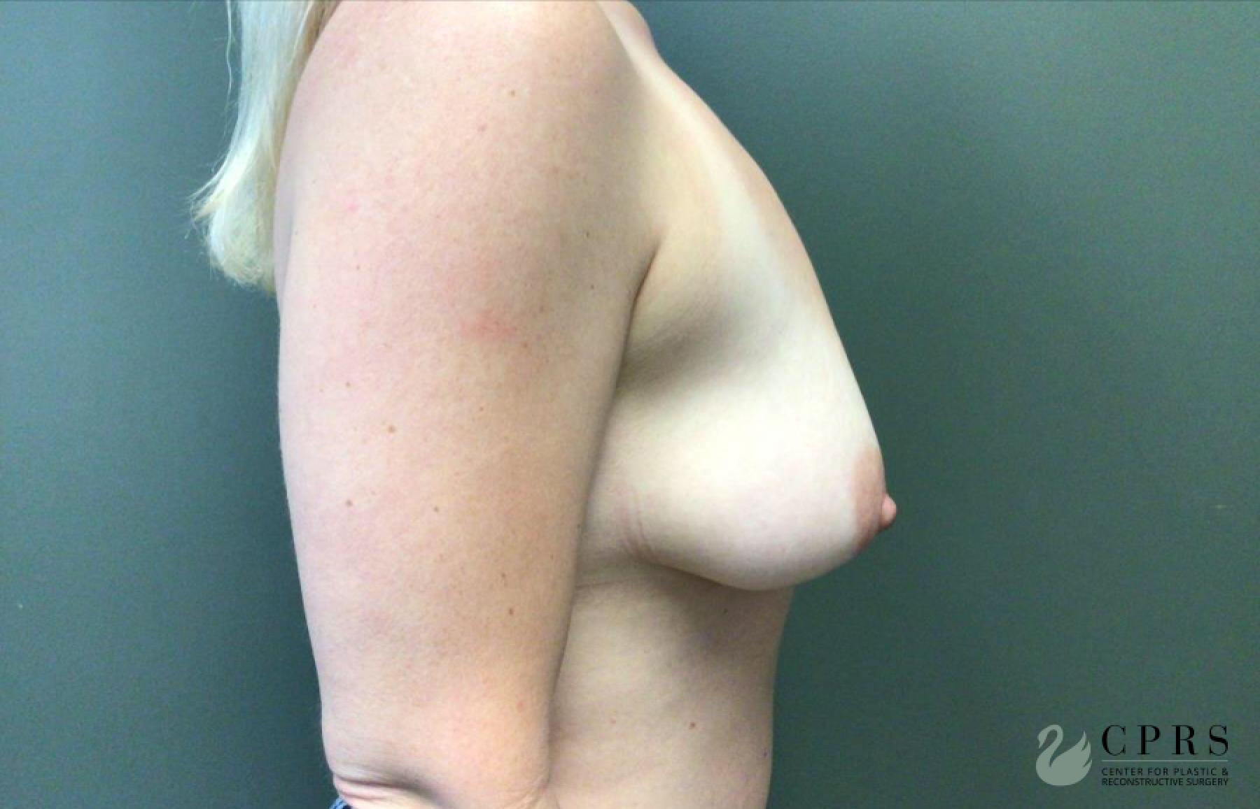 Breast Lift: Patient 6 - Before 1
