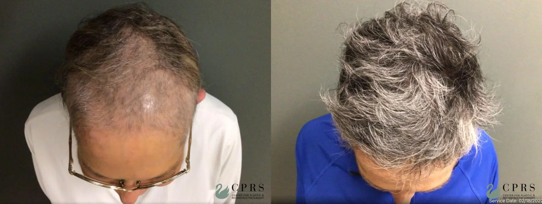 PRP Hair Restoration : Patient 1 - Before and After  