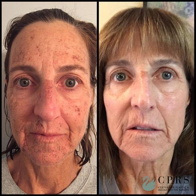 Laser: Patient 6 - Before and After  