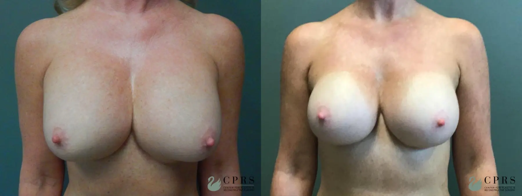 Revision Breast Augmentation : Patient 2 - Before and After  