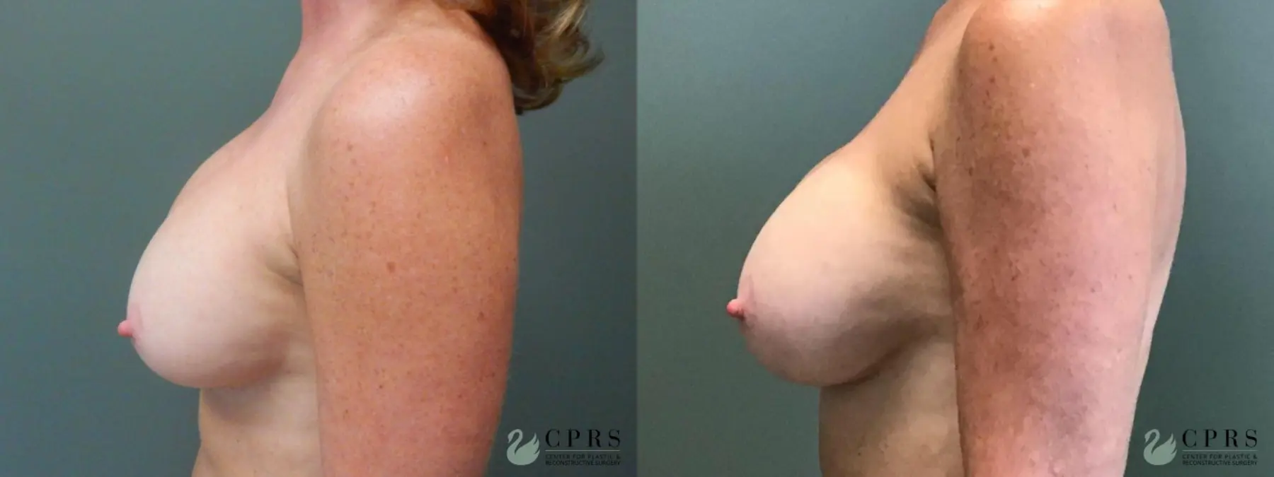 Revision Breast Augmentation : Patient 2 - Before and After 2