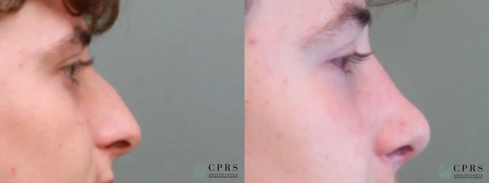 Rhinoplasty: Patient 4 - Before and After  