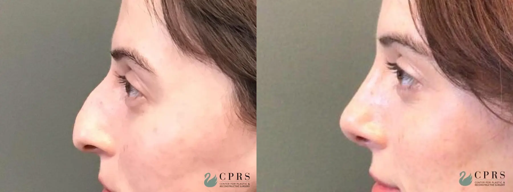 Rhinoplasty: Patient 11 - Before and After  