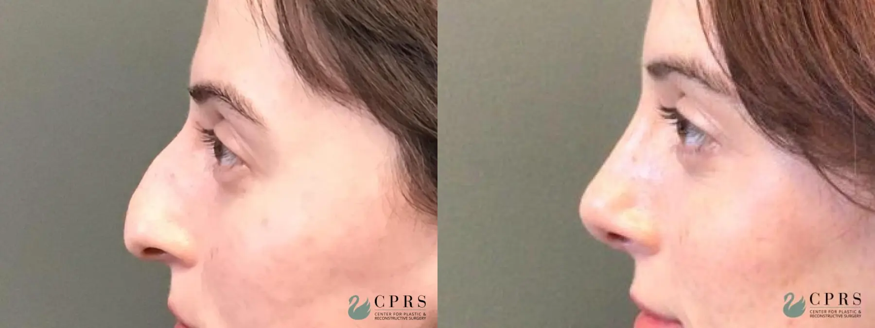 Rhinoplasty: Patient 12 - Before and After  