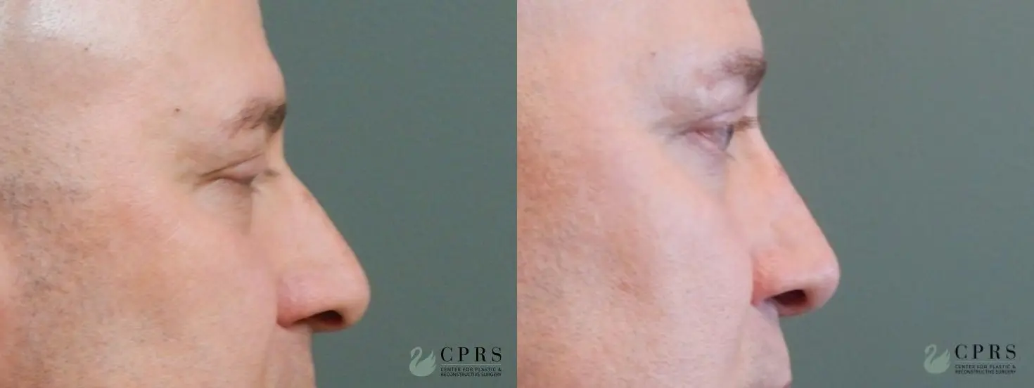 Rhinoplasty: Patient 5 - Before and After  