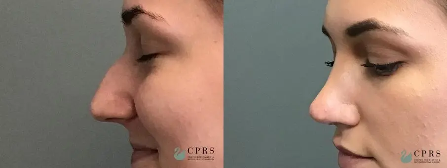 Rhinoplasty: Patient 3 - Before and After  