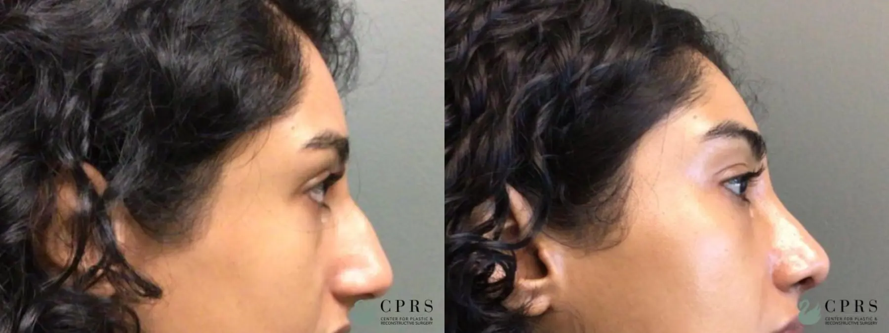 Rhinoplasty: Patient 17 - Before and After 1