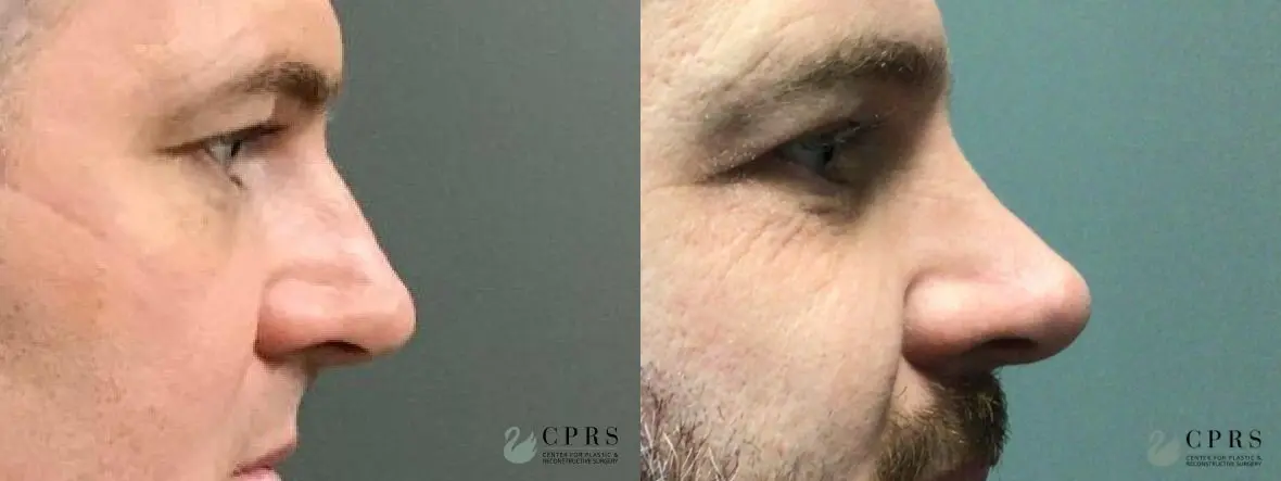 Rhinoplasty: Patient 11 - Before and After  