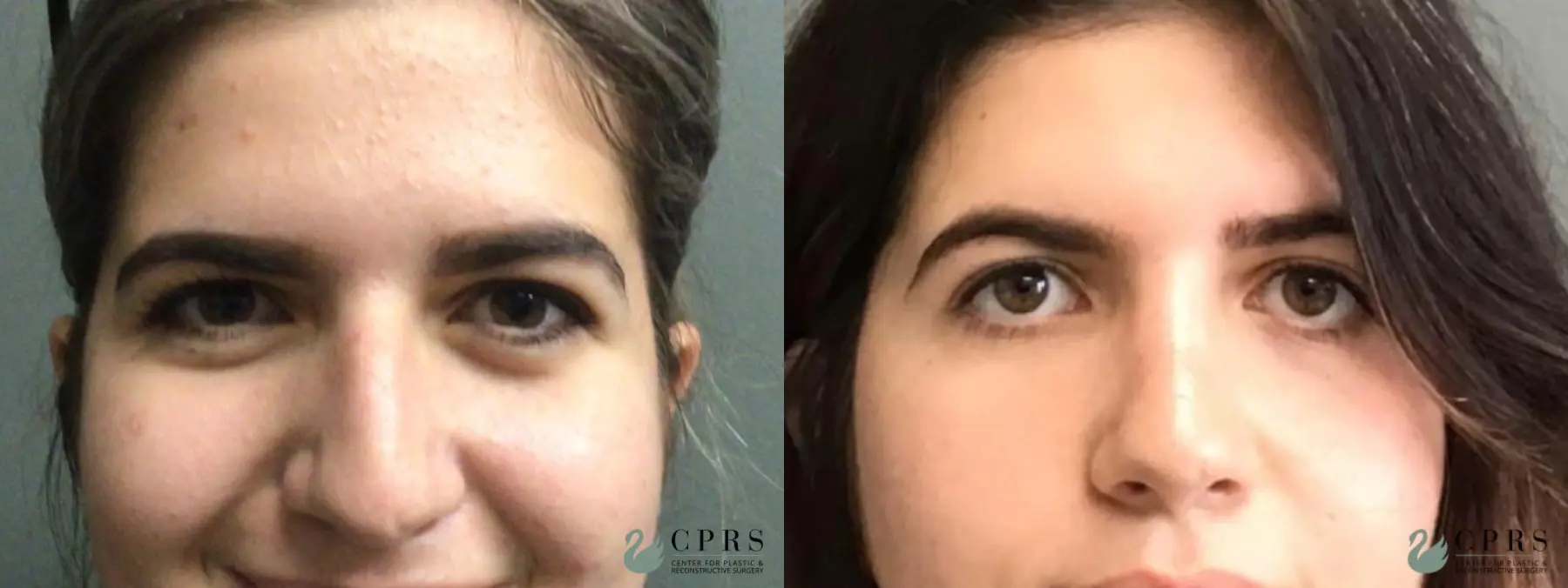 Rhinoplasty: Patient 14 - Before and After  