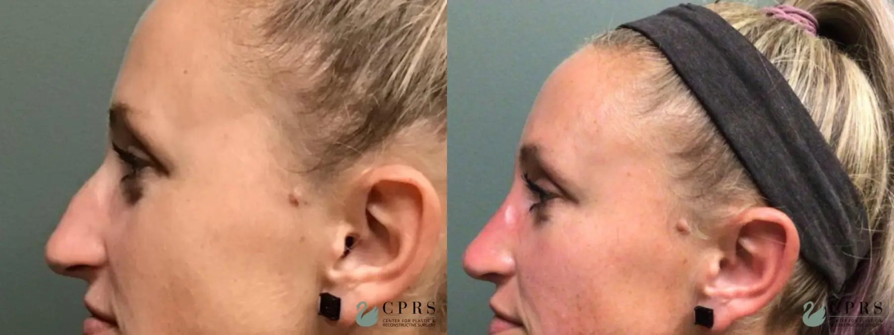 Rhinoplasty: Patient 26 - Before and After  