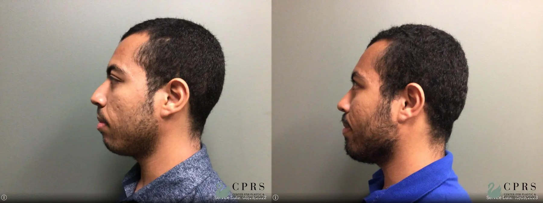 Rhinoplasty: Patient 18 - Before and After 1