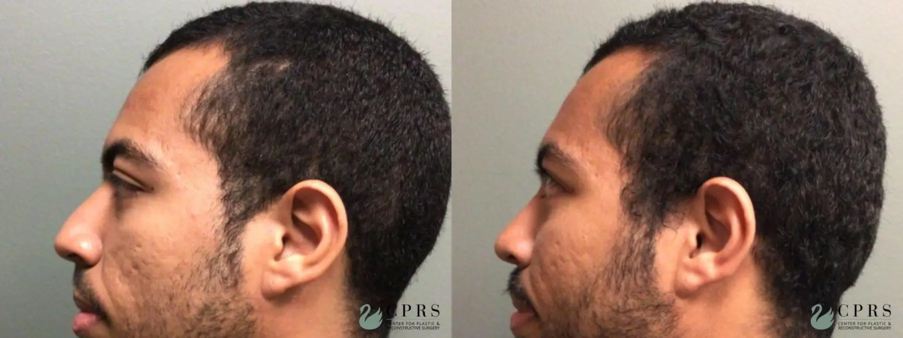 Rhinoplasty: Patient 18 - Before and After  