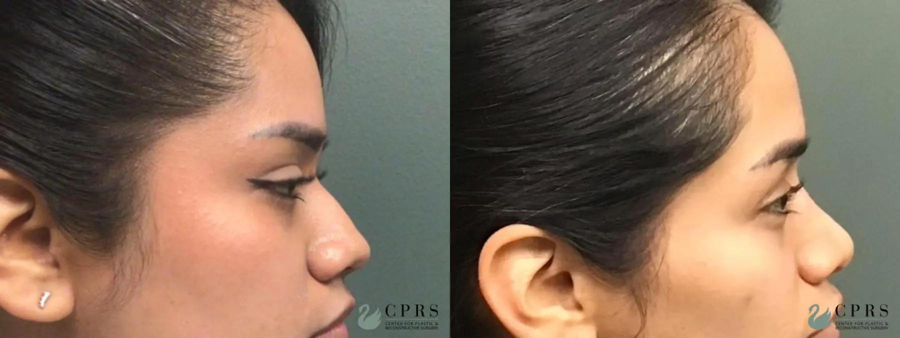 Rhinoplasty: Patient 19 - Before and After  