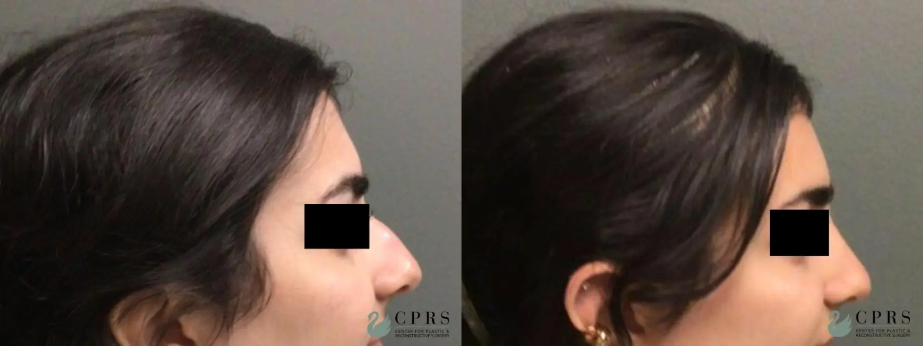 Rhinoplasty: Patient 15 - Before and After 1