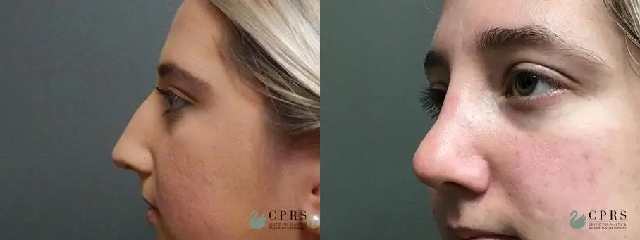 Rhinoplasty: Patient 9 - Before and After  