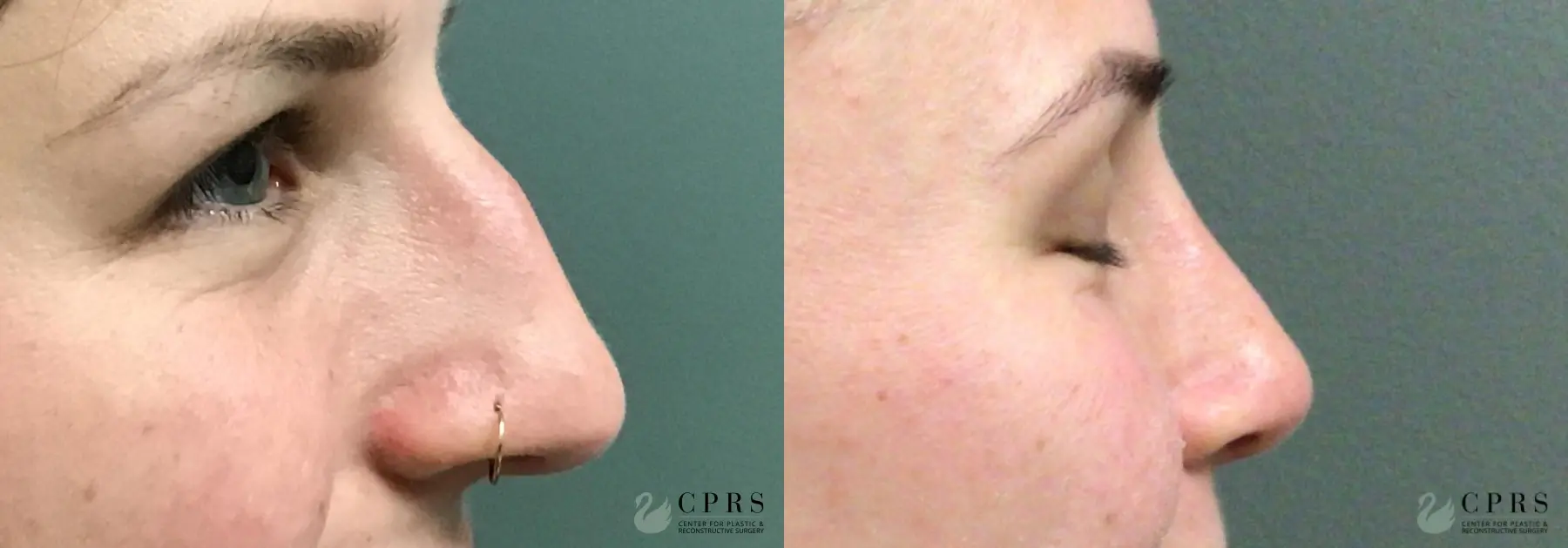 Rhinoplasty: Patient 1 - Before and After  