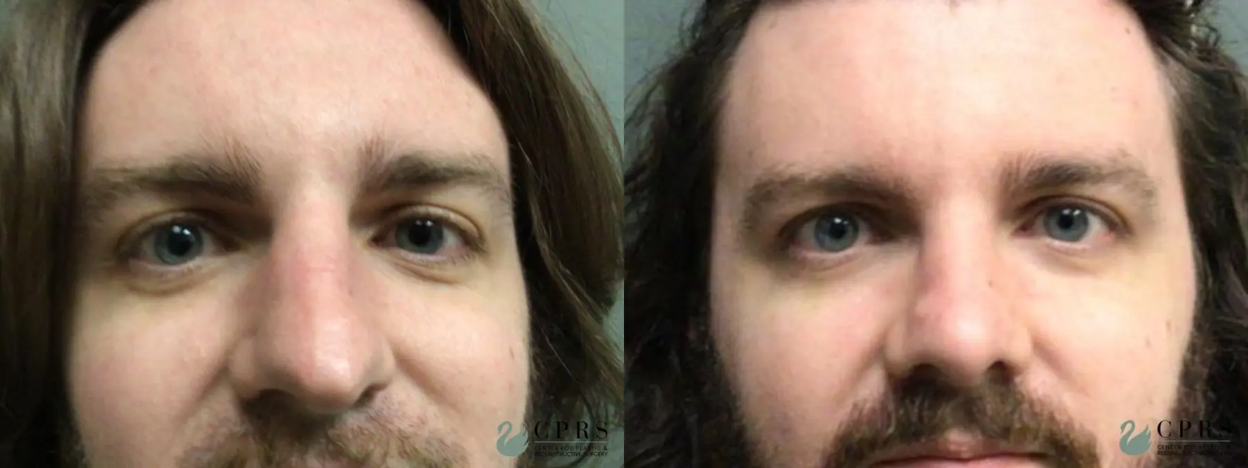 Rhinoplasty: Patient 17 - Before and After  