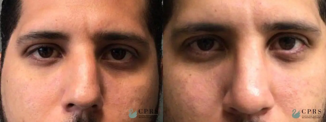 Rhinoplasty: Patient 8 - Before and After  