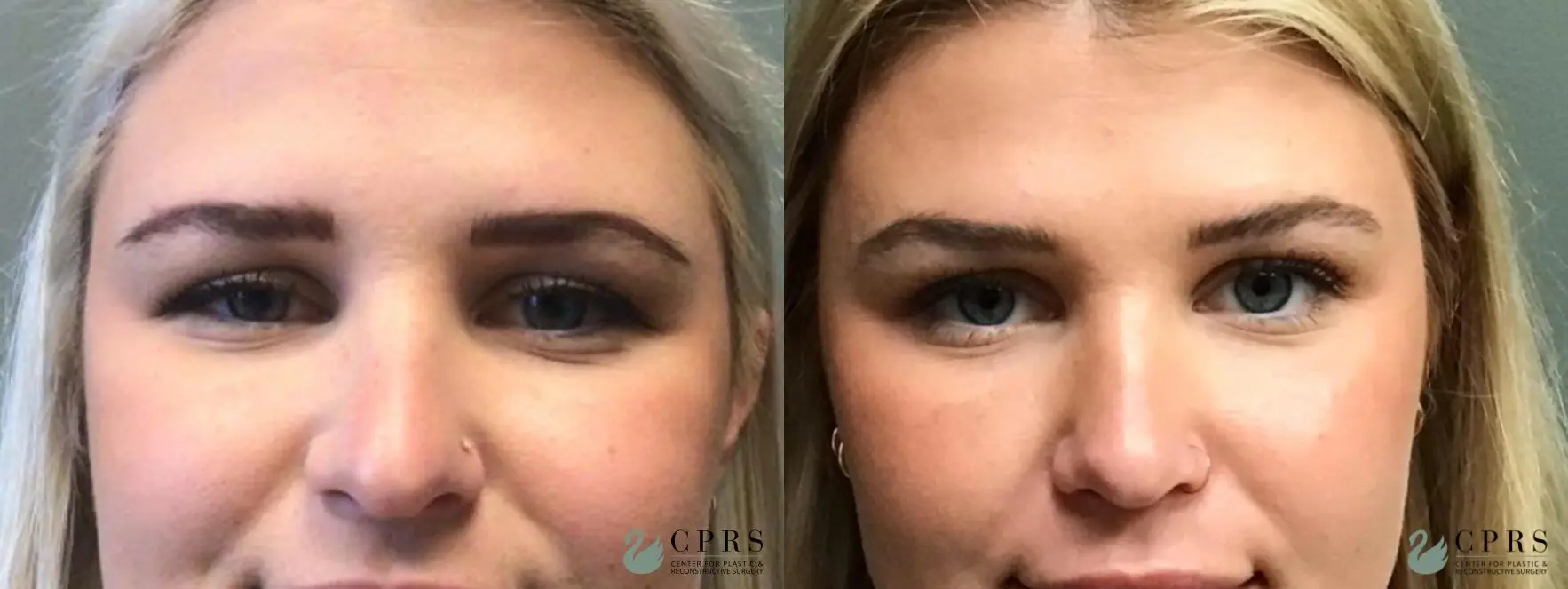 Rhinoplasty: Patient 22 - Before and After  