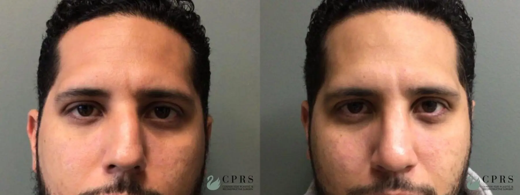 Rhinoplasty: Patient 13 - Before and After 1