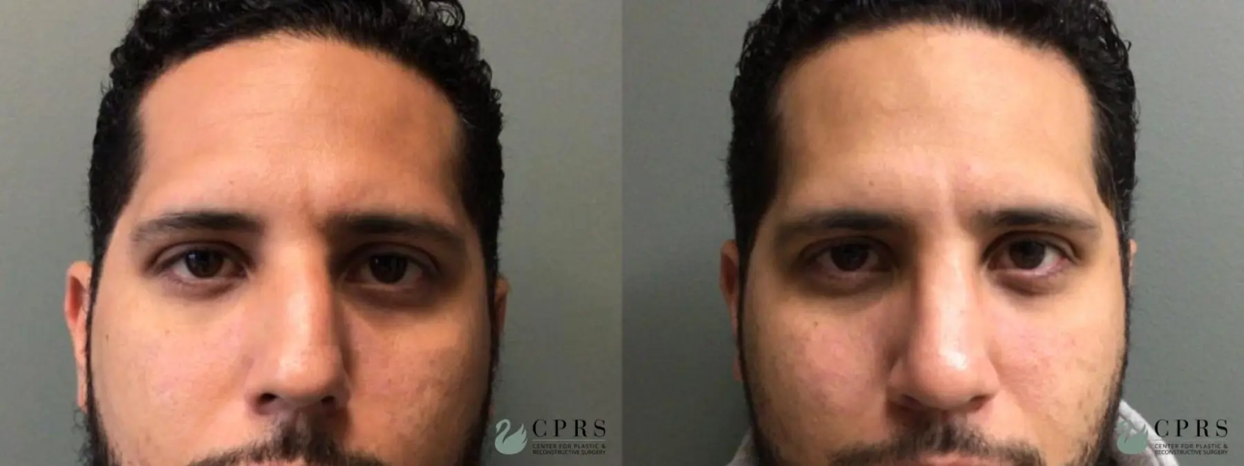 Rhinoplasty: Patient 13 - Before and After  