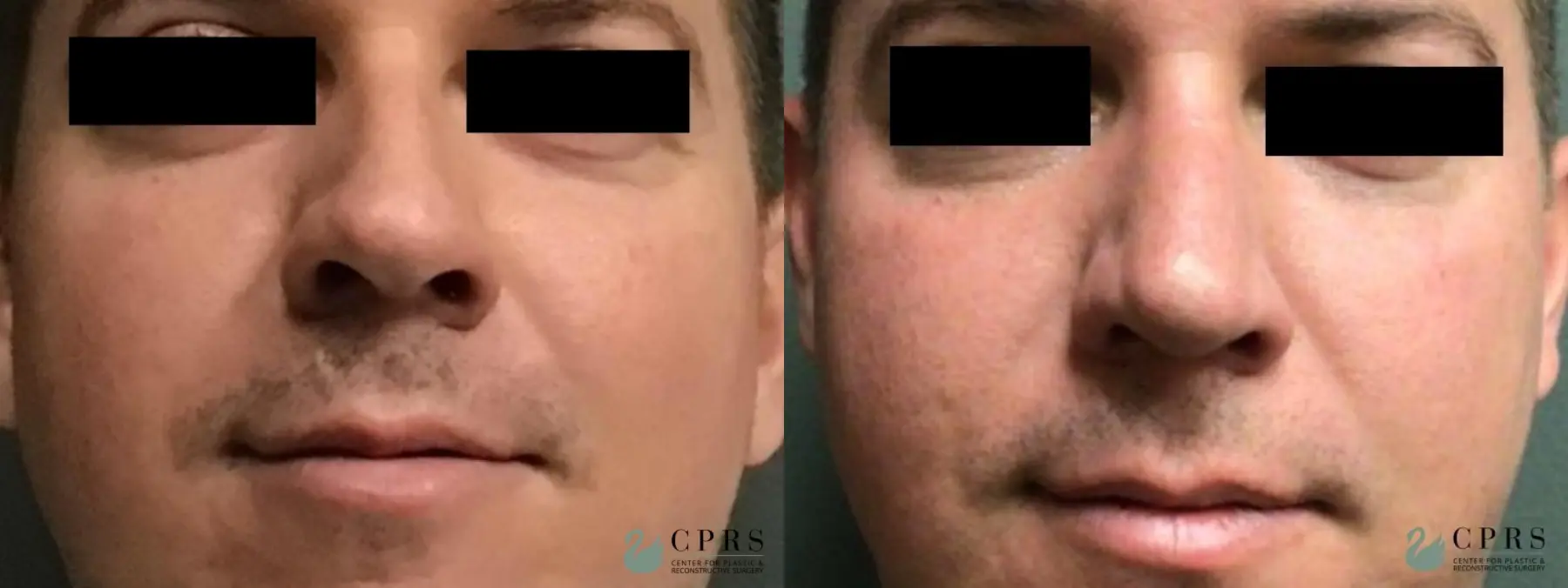 Rhinoplasty: Patient 7 - Before and After  