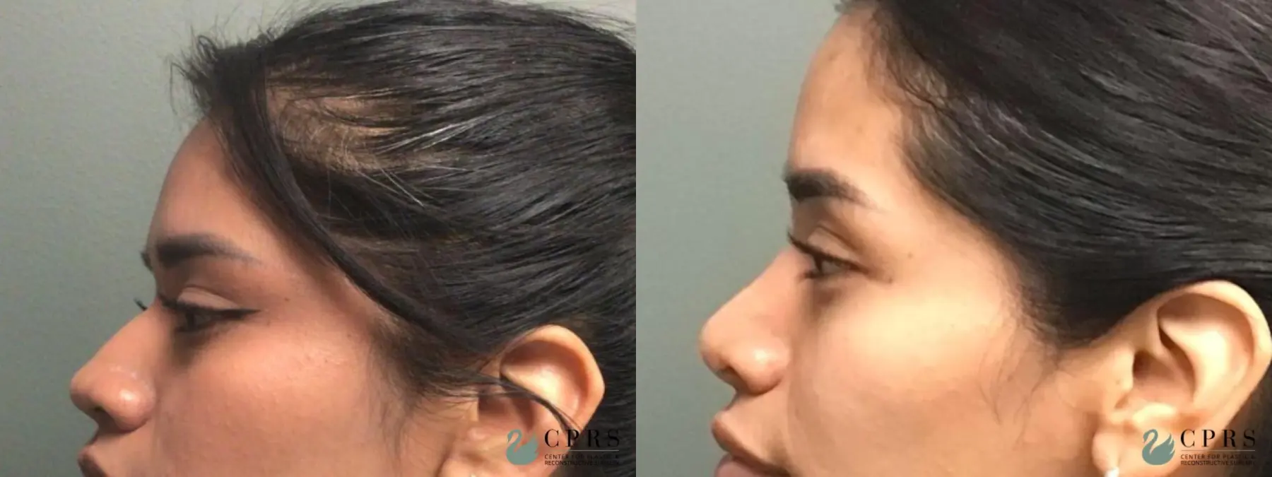 Rhinoplasty: Patient 19 - Before and After 2