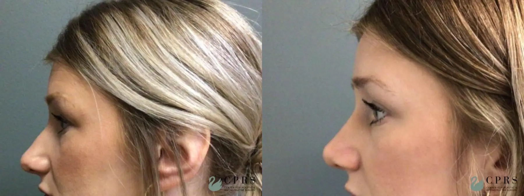 Rhinoplasty: Patient 20 - Before and After  