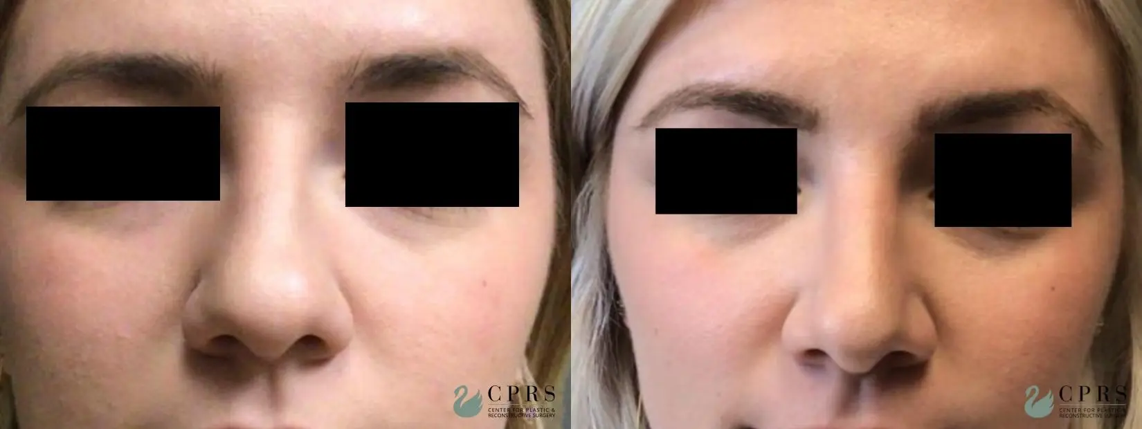 Rhinoplasty: Patient 6 - Before and After 1